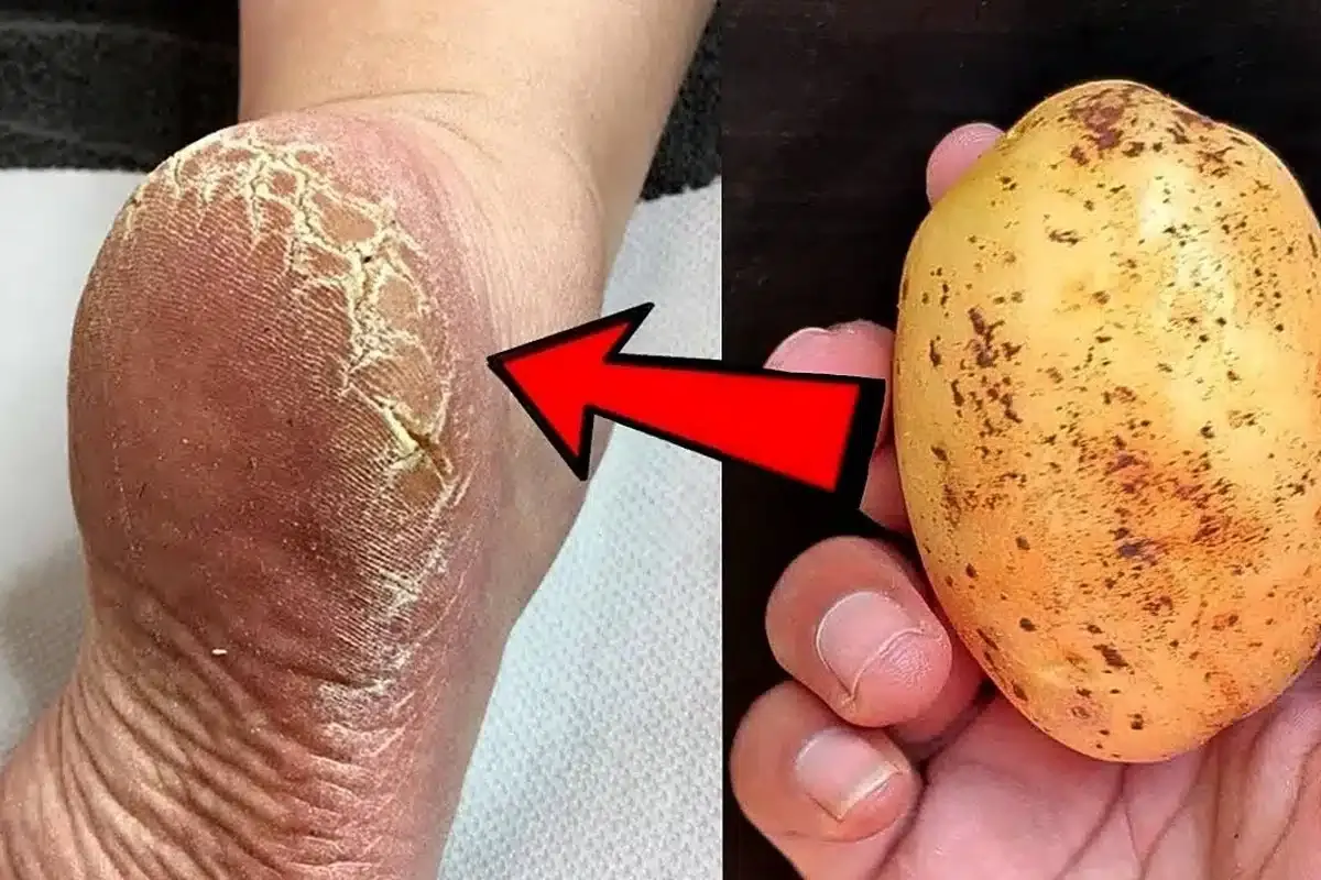 Como acabar com rachaduras dos pés: dica muito prática que aprendi com uma podóloga