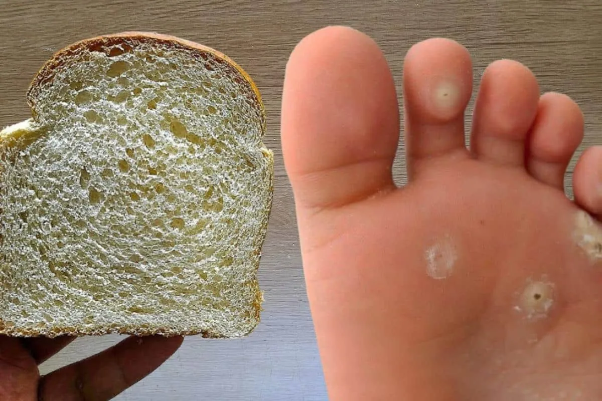 Como combater calos nos pés: a solução que você tanto procurou é mais fácil que você imagina