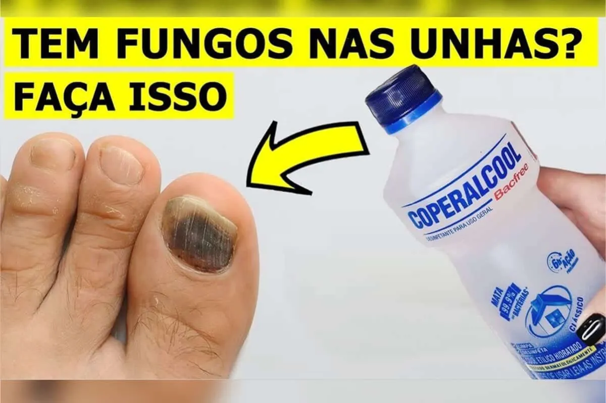 Como eliminar fungos das unhas: segredo de podologia que nunca te contaram