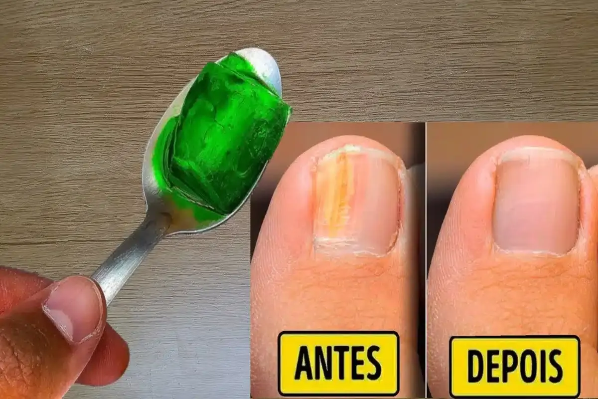 Como eliminar micose da unha: a melhor dica caseira para você resolver esse problema