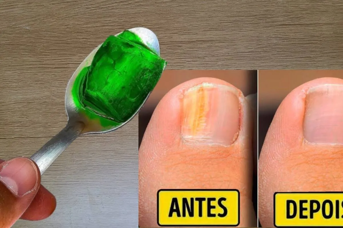 Como eliminar micose da unha: técnica fácil que aprendi com uma manicure