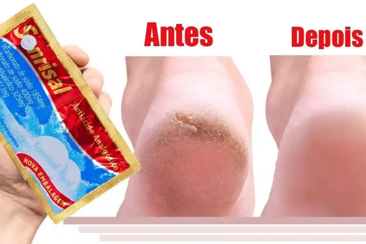 Como hidratar pés rachados e ressecados sem precisar de cosmético caro de farmácia