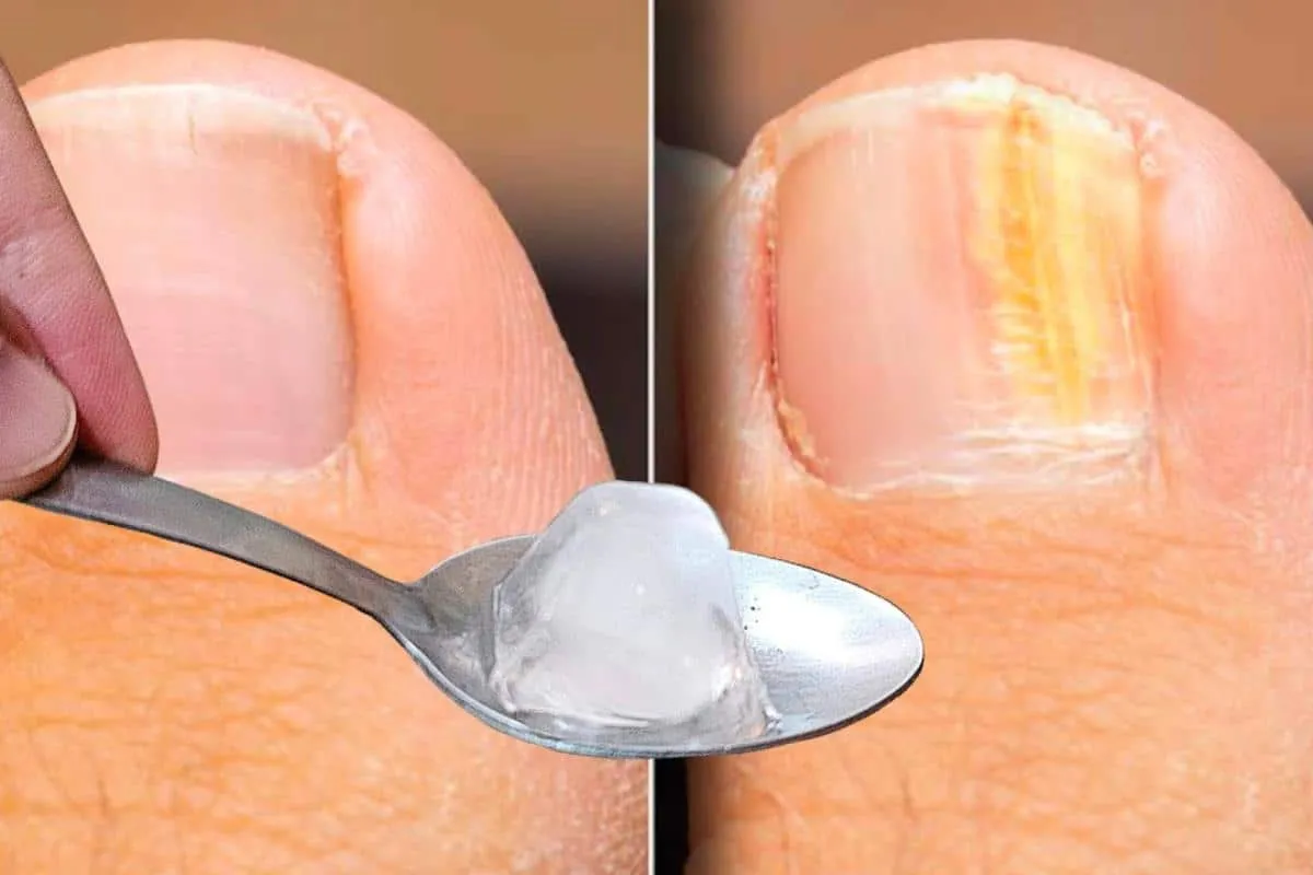 Como remover micose da unha sem precisa comprar cosmético caro na farmácia