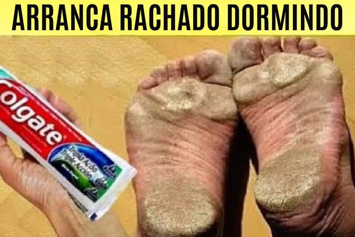 Como tirar rachaduras dos pés: a solução definitiva que você tanto procurou