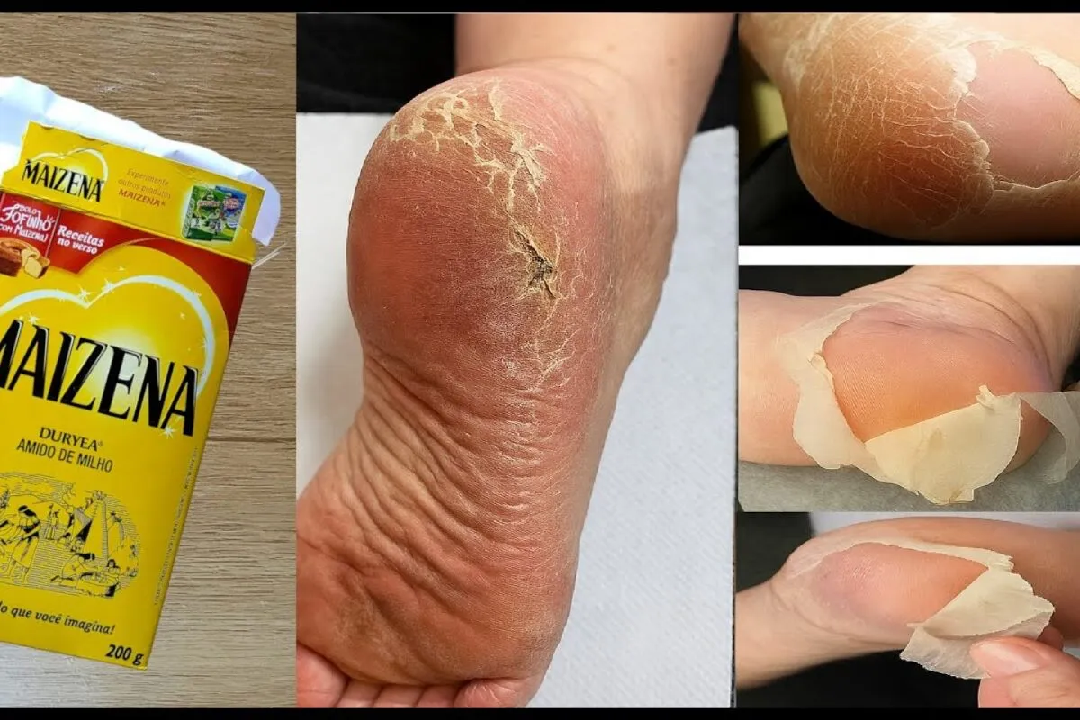 Como tirar rachaduras dos pés com receita simples que funciona sem precisar de médico