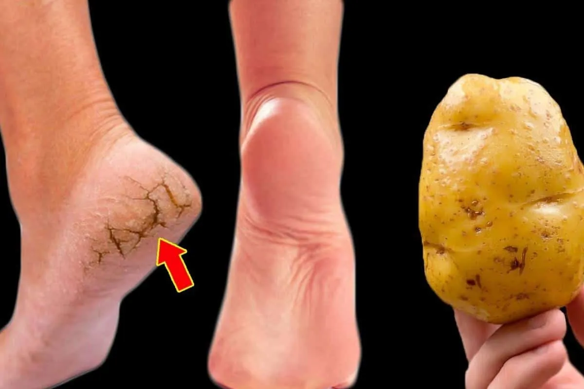 Como tirar rachaduras dos pés: uma podóloga profissional me ensinou um segredo incrível