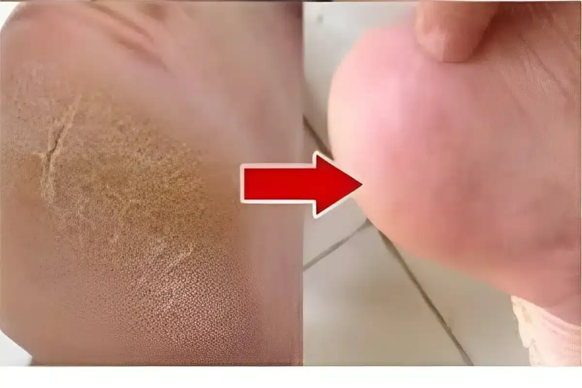 Dica caseira para pés rachados e ressecados: fica lisinho igual pezinhos de bebê