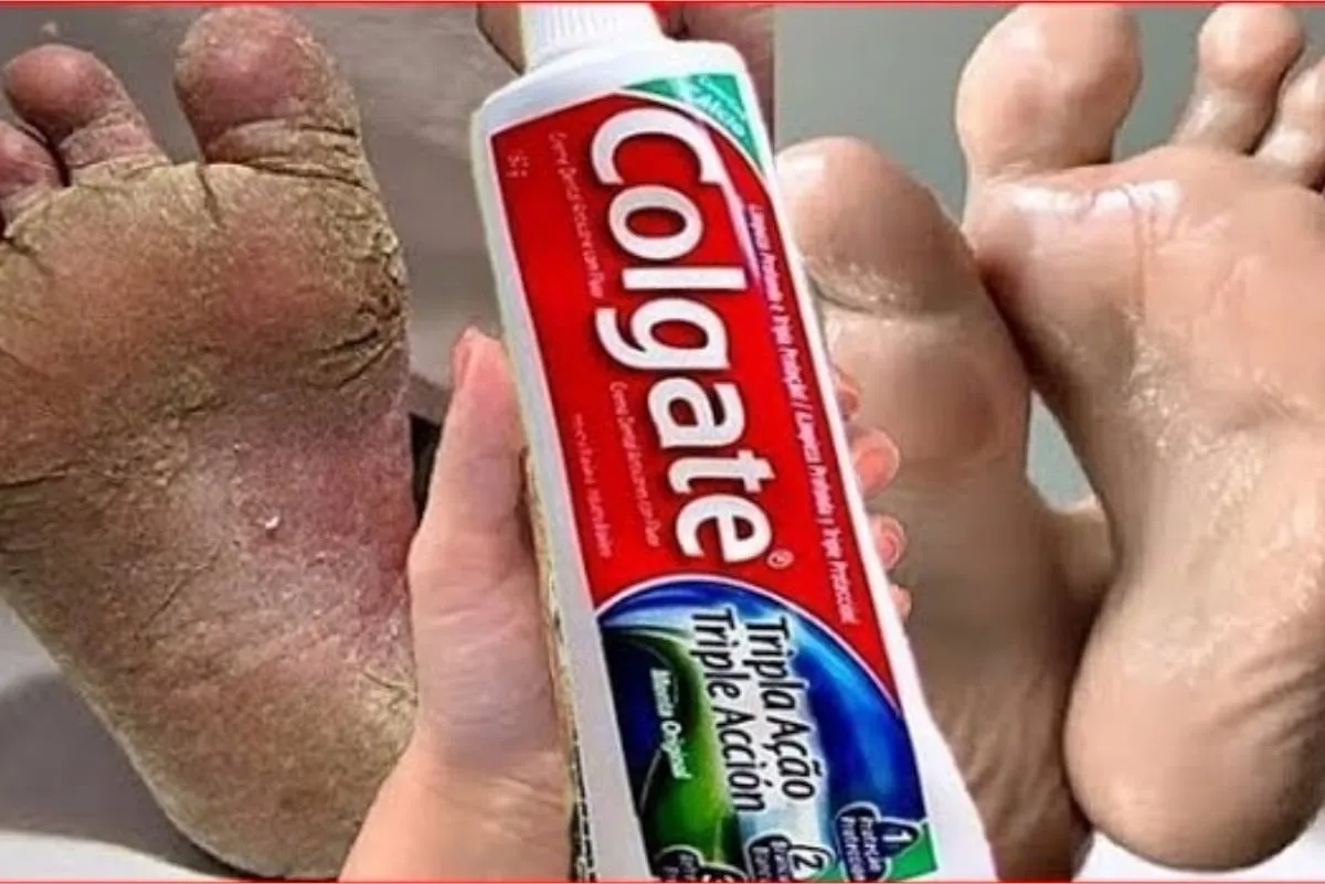 Dica para pés ressecados: tira as rachaduras e calosidades em pouco tempo