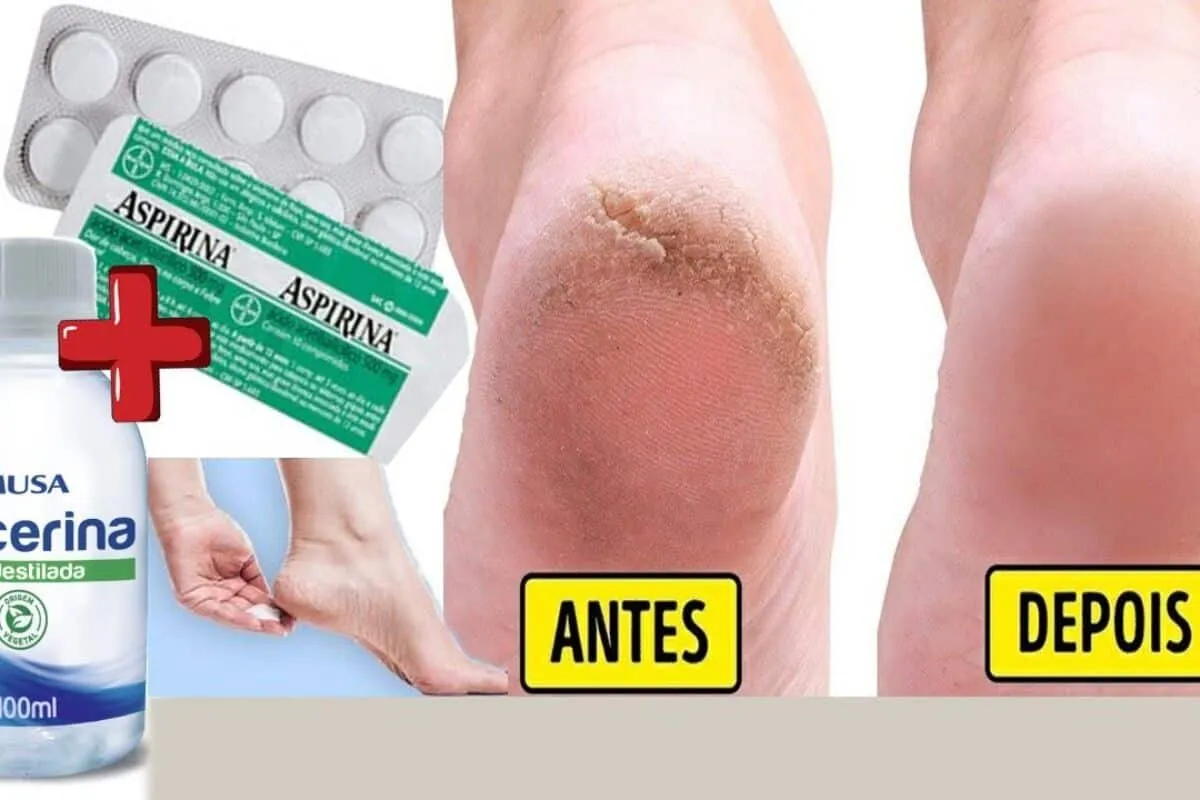 Hidratante caseiro para pés rachados que deixa a pele lisinha