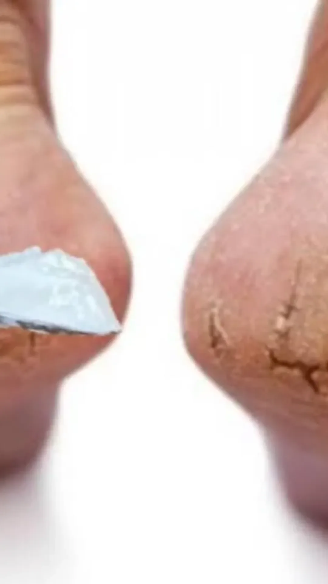 Como alisar pés rachados: não precisa gastar dinheiro com produto caro