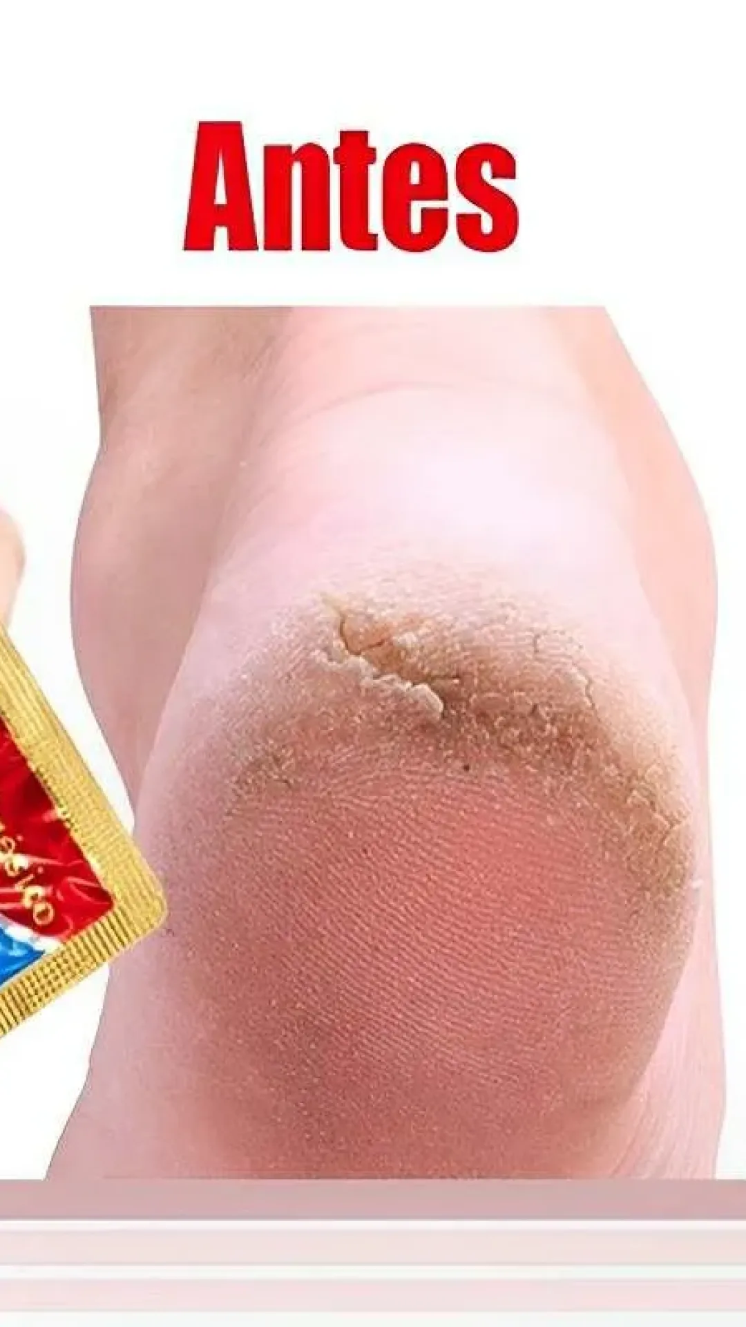 Como hidratar pés rachados usando 3 ingredientes que você tem no armário