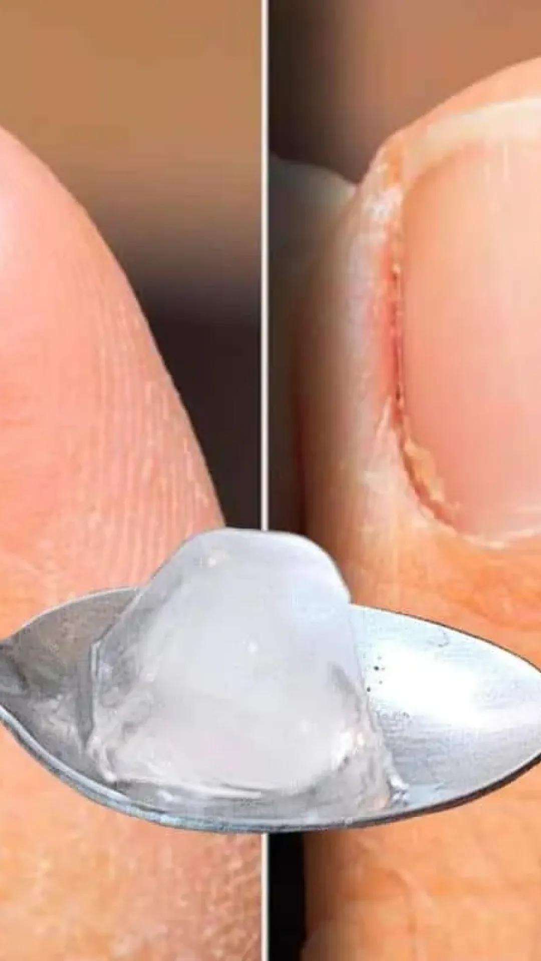 Como remover micose da unha sem precisa comprar cosmético caro na farmácia