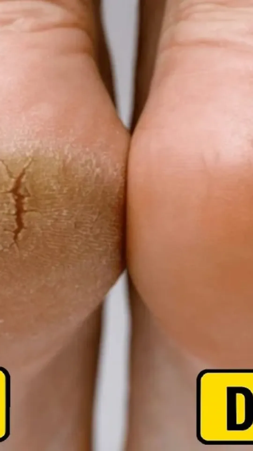 Como tirar rachadura dos pés: dica caseira e super barata para tirar todo ressecamento