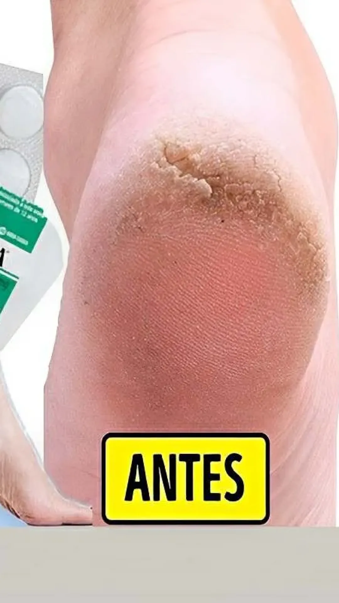 Fiz esse hidratante caseiro para pés rachados e o resultado foi surpreendente
